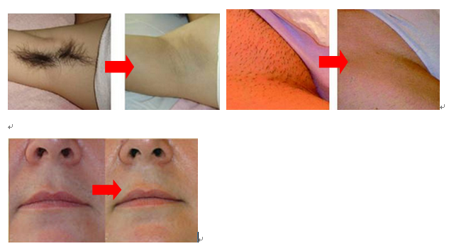 Multifunction Beauty 808nm Diode Laser Hair Removal Machine , Body / Face / Leg Hair Removal Machine