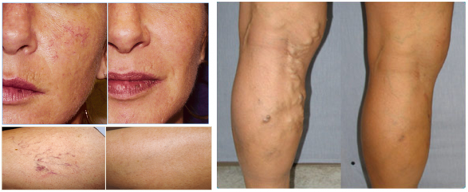 Painless Spider Vein Removal Machine , Diode Cosmetic Laser Equipment for EVLT