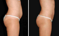 Women Facial / Body / Arm Lipo Cavitation fatty acids Machine Ultrasonic Vacuum Fractional RF