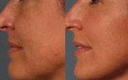 Women Facial / Body / Arm Lipo Cavitation fatty acids Machine Ultrasonic Vacuum Fractional RF