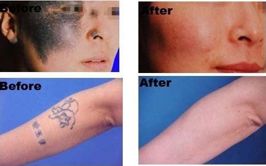 IPL Hair Removal Machine 3500W Vertical 3Handles E-light TruMED(SHR+IPL+Nd:Yag)