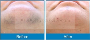 Portable 808nm Diode Laser Hair Removal Machine CE Pulse Duration