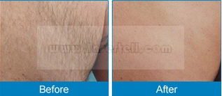 Portable 808nm Diode Laser Hair Removal Machine CE Pulse Duration