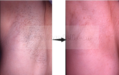 Women SHR IPL Beauty Equipment for Hair Removal Skin Rejuvenation Single Pulses