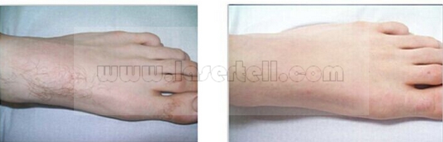 Women SHR IPL Beauty Equipment for Hair Removal Skin Rejuvenation Single Pulses