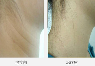 Multifunction Rejuvenation Diode Laser Hair Removal Machine Adjustable Fluence