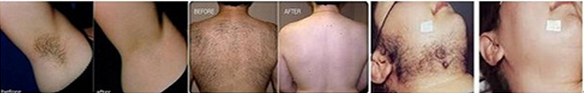 DILAS Micro Channel Cooling 808 Diode Laser Hair Removal Equipment 600W