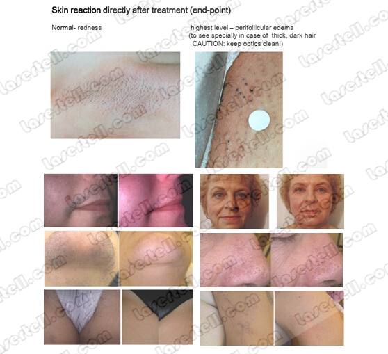 755nm Alexandrite Laser Machine Hair Removal 60x65mm Spot Size AlexMED