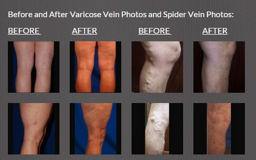 0.05s Pulse Spider Vein Removal Machine , Portable Skin Rejuvenation Equipment