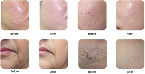 Best price SHR IPL hair removal beauty device EpiMED-