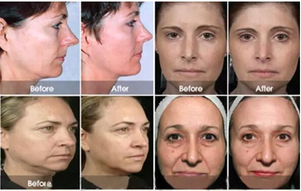 3D Anti - Aging Hifu Beauty Machine Beauty Salon Equipment For Skin Tightening