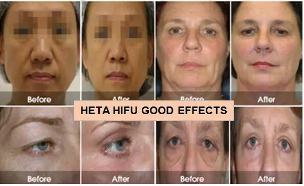 20000 Shots 3D Hifu Facelift Machine 8 Cartridges With 1-11 Lines