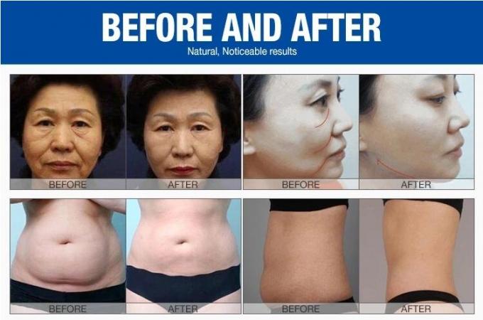 150VA Hifu Skin Tightening Machine 8 Cartridges / Hifu Slimming Machine 15 Inch Screen