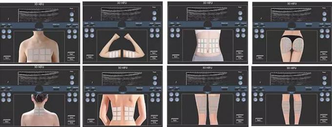 Non - Invasive 150VA Hifu Beauty Machine 15000 Shots With Foldable Screen