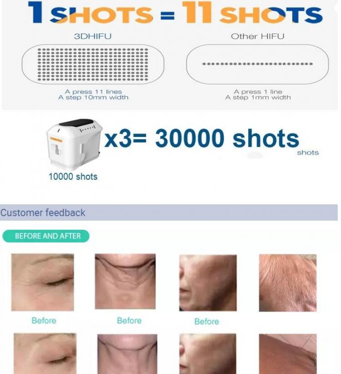 Ultrasound Portable Hifu Beauty Machine 50-60Hz Intensity Focused CE Approval