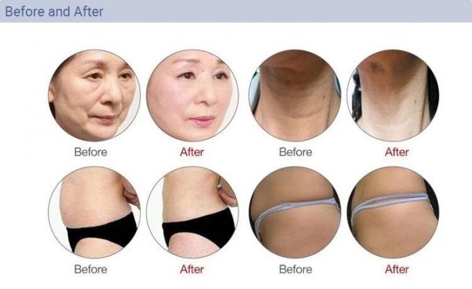 Anti Wrinkle 2D Hifu Beauty Machine 44×30×38 Cm With FDA Certificate