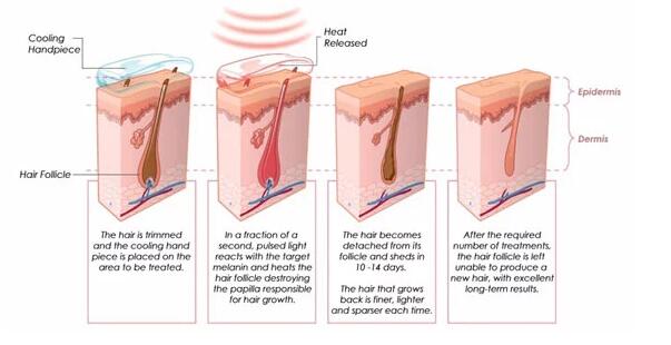 3 Wavelength Laser Hair Removal Equipment For Underarm / Bikini Area