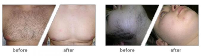 808nm Permanent Hair Removal Laser Machine , Unwanted Hair Removal Machine