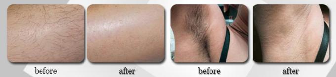 808nm Permanent Hair Removal Laser Machine , Unwanted Hair Removal Machine