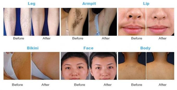 Permanent IPL Laser Machine 808nm Diode Laser System For Black / Brown Skin Color