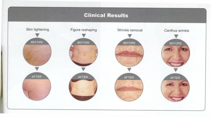 rf face skin tight machine