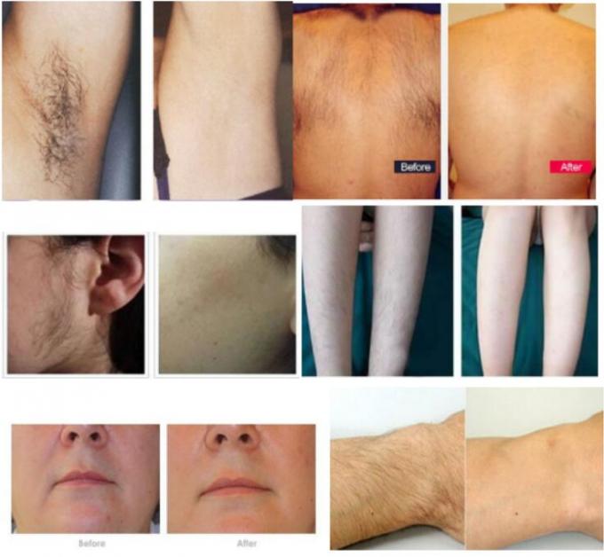 Simple Design and Protable 808nm Fiber Laser beauty machine/diode laser hair removal machine
