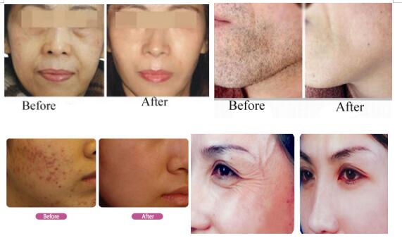 Protable White Hair Removal and Skin Rejuvenation Beauty Machine/Two Handpieces