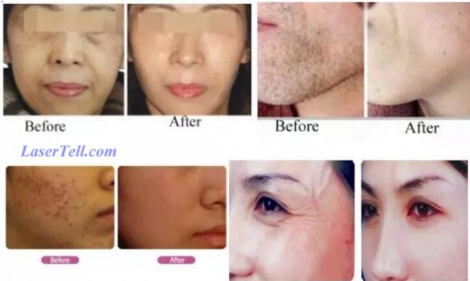 New 808nm fiber coupled diode laser/diode laser hair removal machine