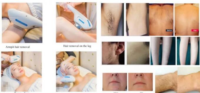 808nm Diode Laser Hair Removal Machine Triple Wavelength 755nm 808nm 1064nm